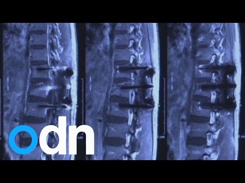 إجراء أول جراحة فى النخاع الشوكى لمريض صيني