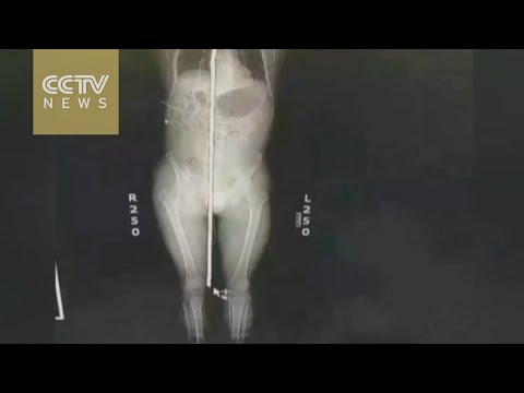 رجل ينجو من الموت بعد اختراق سيخ حديد جسده