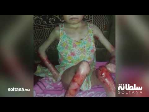 أسماء من تارودانت تعاني من مرض نادر حول حياتها الى جحيم وتحتاج لعملية عاجلة