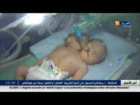 شاهد  ولادة طفلة برأسين وجسد واحد في قطاع غزة