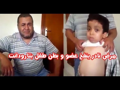 مرض نادر ينفخ عضو وبطن طفل