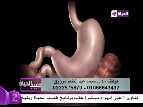 شاهد  فيديو يوضح كيفية وآلية عمل عملية تكميم المعدة
