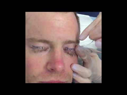 إزالة تاتو يتسبب في سقوط رموش أحد الممثلين