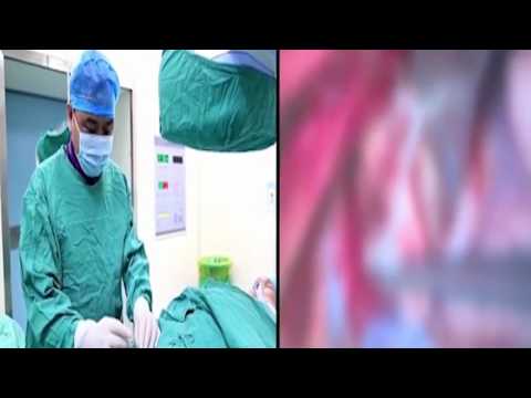 شاهد دودة شريطية تعيش في مخ مراهق لمدة عامين