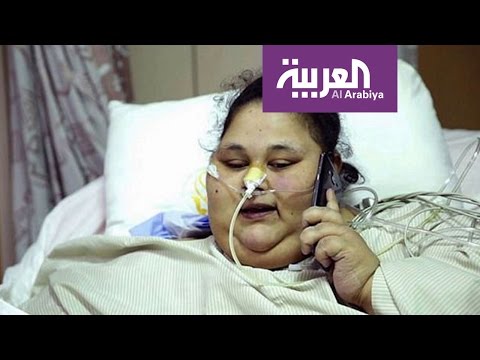 أسمن فتاة في العالم تعاني من خلل جيني يعوق علاجها