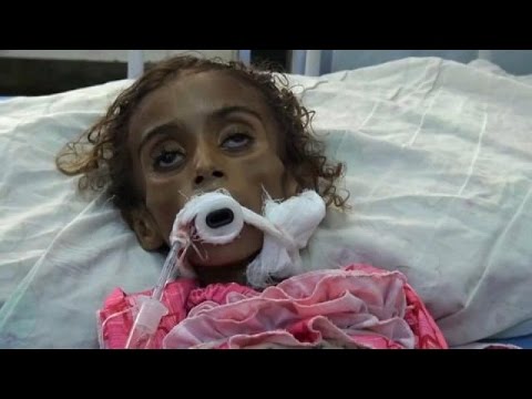 شاهد ديدان تفتك بطفلة في اليمن