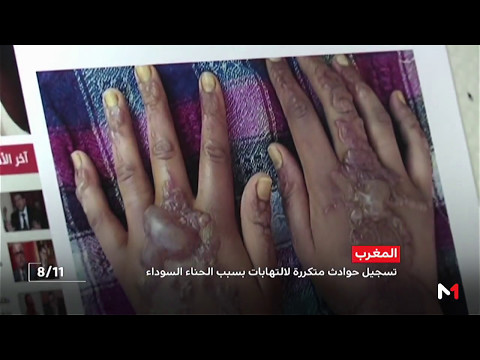 شاهد تسجيل حوادث متكررة للالتهاب بسبب الحناء السوداء