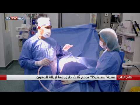 شاهد ابتكار تقنية جديدة وآمنة لشفط الدهون