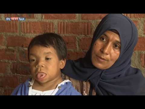 شاهد محمد عبد الرحمن يعاني من حالة طبية نادرة