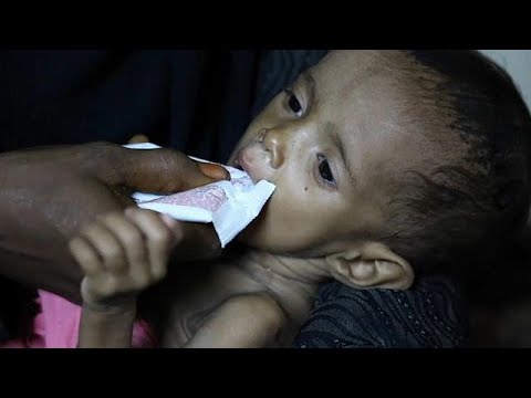 شاهد سوء التغذية ومرض الكوليرا يفتكان بأطفال اليمن