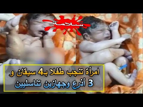 امرأة تنجب طفلًا بـ 4 سيقان و3 أذرع