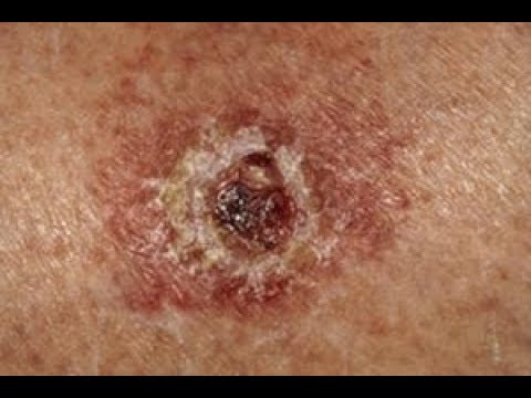 شاهد 5 علامات تُنذرك مبكرًا بسرطان الجلد