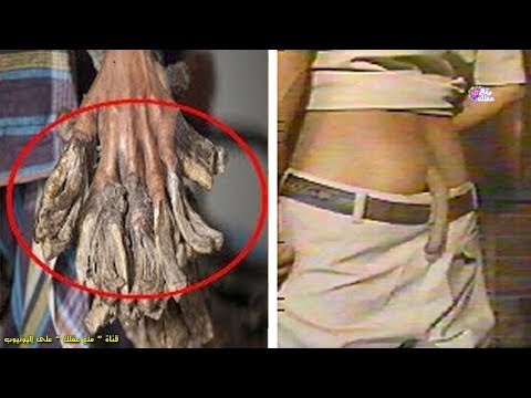 أغرب 5 أمراض ناتجة عن طفرات جينية تم تسجيلها علمياً