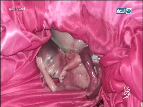 سيدة تلد داخل سيارة وهي على بُعد أمتار من المستشفى
