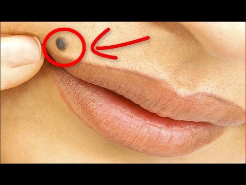 أسباب وجود الشامات على جسم الإنسان ومدى خطرها على الصحة