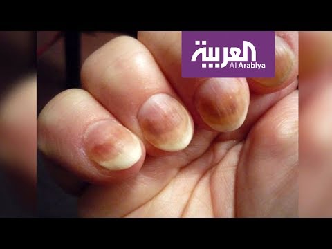 الليزر البارد أحدث طرق علاج فطر الأظافر