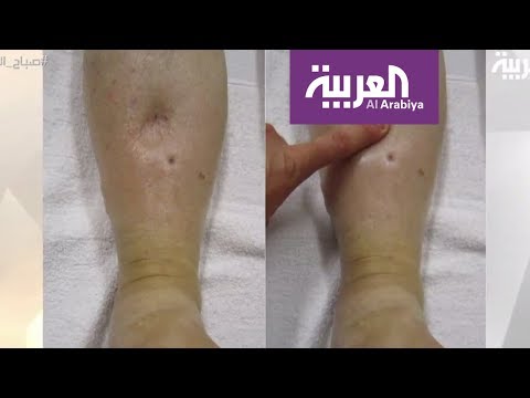 شاهد كيفية التخلص من احتباس الماء في الجسم