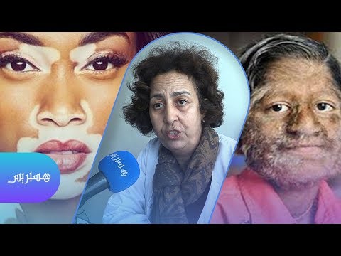 شاهد مليون ونصف مغربي يعانون أمراض نادرة وأعراضها غريبة