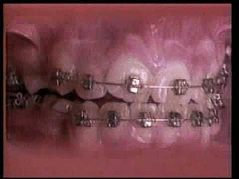 كيف يحول تقويم الأسنان شكل فمك