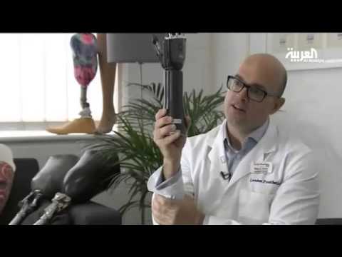 شاهد 14 مليون شخص في العالم مبتوري الأطراف شاهد 14 مليون شخص في العالم مبتوري الأطراف