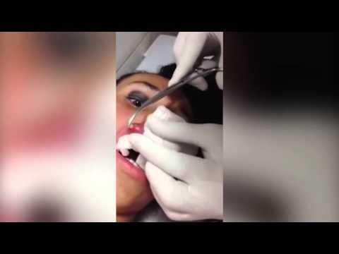 طبيب ينزع دودة حية من شفاه فتاة