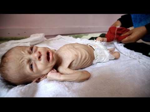 أكثر من 1000 طفل بين قتيل وجريح في اليمن