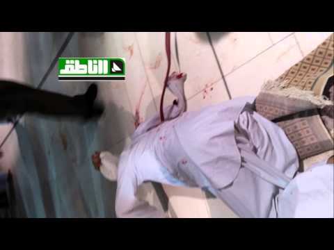 شاهد استخراج سيخ حديد من جسد مصاب