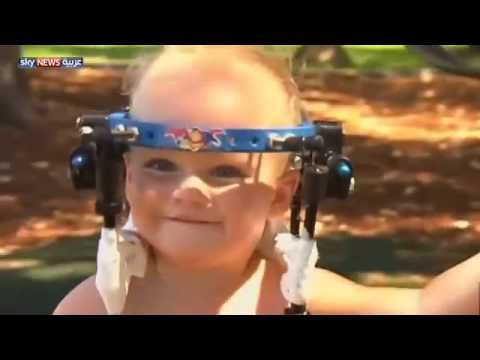 شاهد معجزة تعيد تثبيت رأس طفل