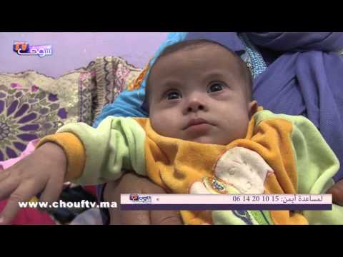 شاهد رضيع بـ3 ثقوب في القلب