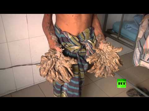 شاهد ظهور الرجل الشجرة من بنغلاديش