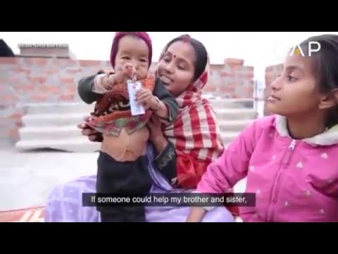 شاهد لقطات مخيفة لأطفال بتجاعيد وترهلات مثل العواجيز