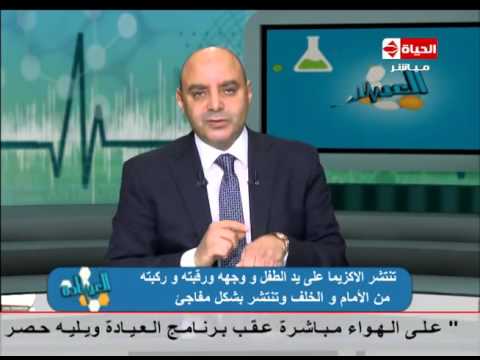 الدكتور رفعت الجابري يكشف سبب النزف تحت الجلد وظهور بقع زرقاء