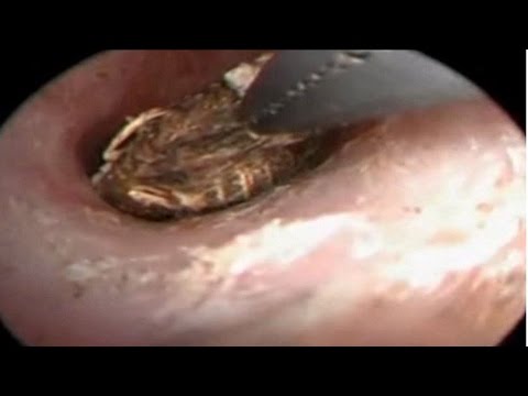 العثور على مخلوق غريب يعيش داخل أذن امرأة