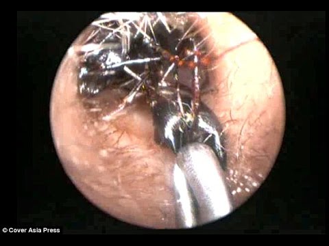 نمل كبير الحجم يعيش داخل أذني طفلة هندية