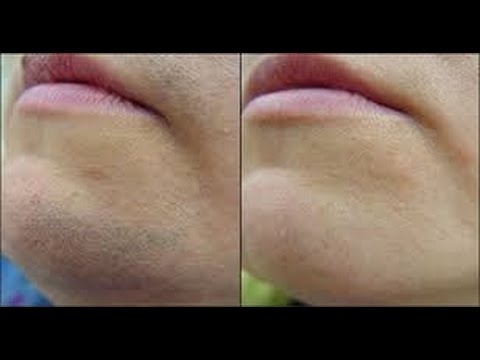 شاهد زيت النمل لازالة الشعر من الوجه مع غزلان مكوار