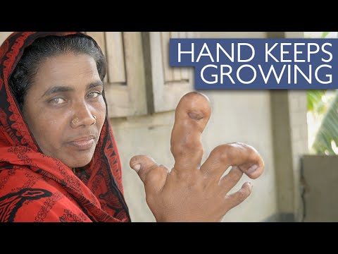 سيدة تعاني من مرض يجعل كف يدها في حجم كرة قدم